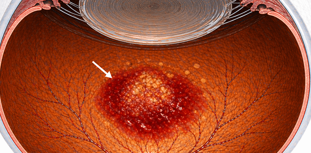 cataract eye image
