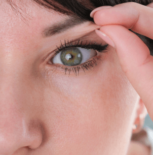 Blépharoplastie